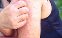 Kızamık belirtileri neler, nasıl geçer?