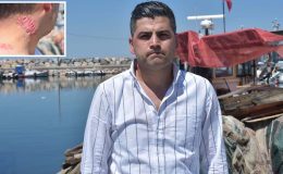 Lazer tedavisi sonrası hayatı karardı